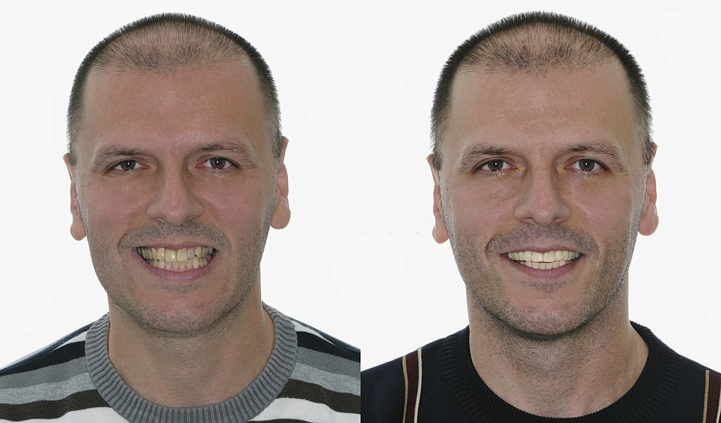 ALL-ON-4 Dental Implants before and after