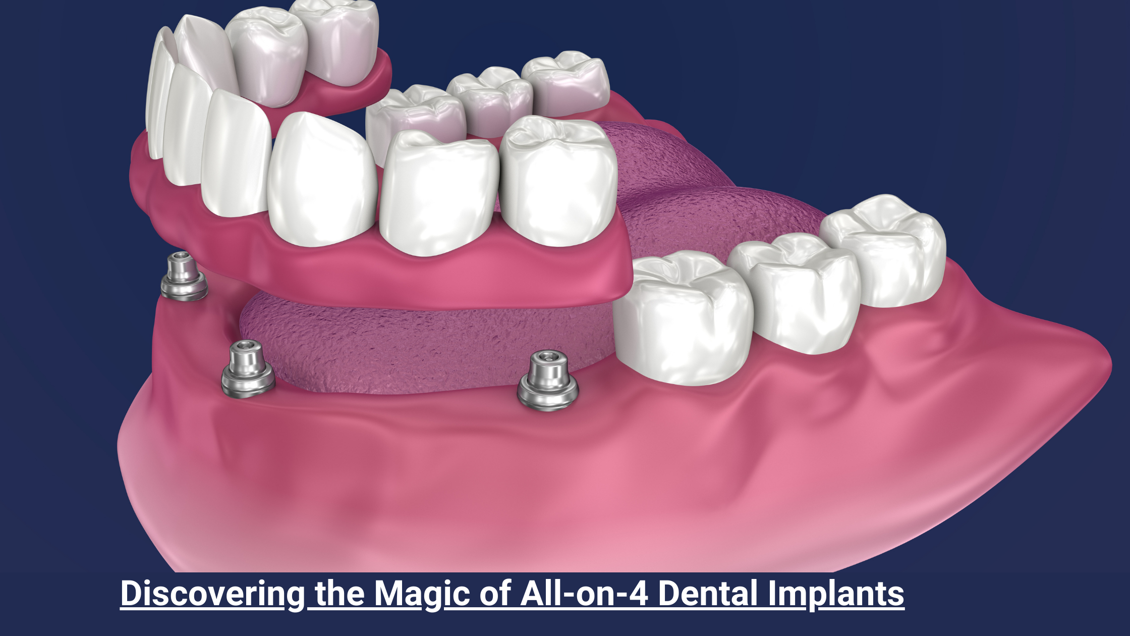 All On 4 Dental Implants Las Vegas