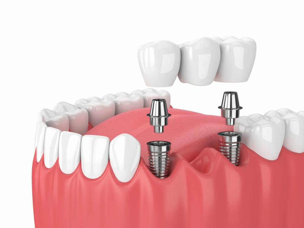 3d render of jaw and implants with dental bridge over white background